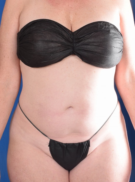 Torso Liposuction Before & After Patient #1072