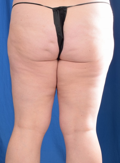 Legs Liposuction Before & After Patient #1081