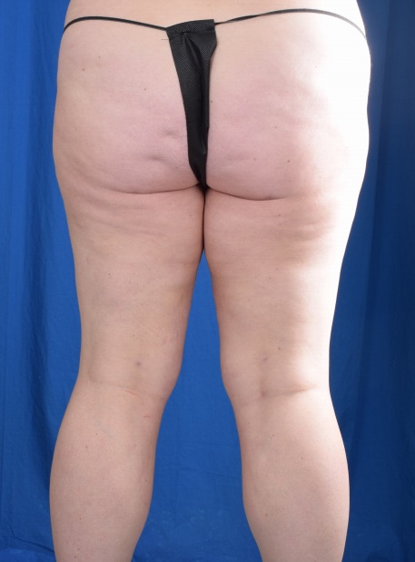 Legs Liposuction Before & After Patient #1081