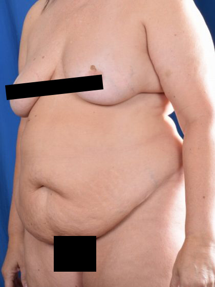 Tummy Tuck Before & After Patient #1086