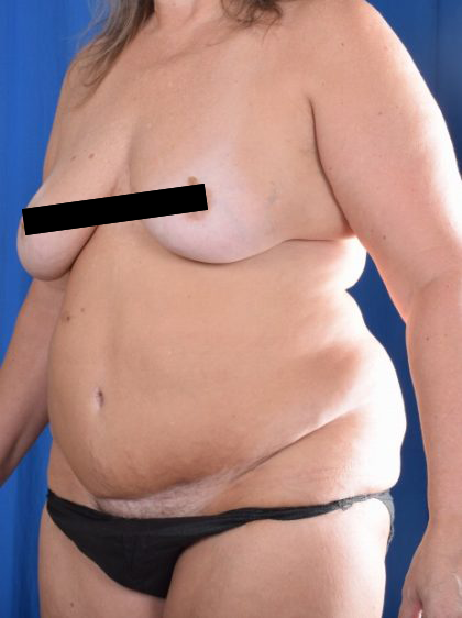 Tummy Tuck Before & After Patient #1086