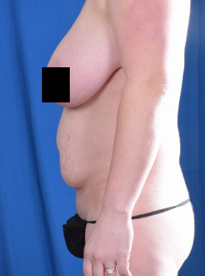 Tummy Tuck Before & After Patient #1089
