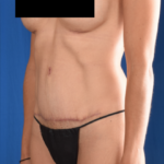 Tummy Tuck Before & After Patient #1167
