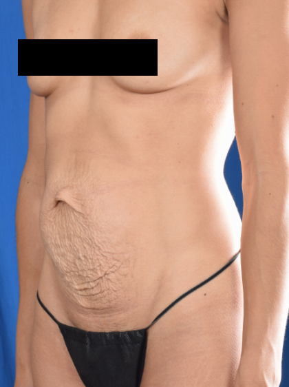 Tummy Tuck Before & After Patient #1167