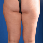 Legs Liposuction Before & After Patient #1329