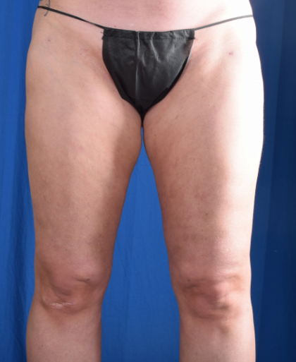Legs Liposuction Before & After Patient #1334