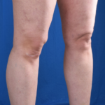 Legs Liposuction Before & After Patient #1334
