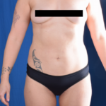 Torso Liposuction Before & After Patient #1420