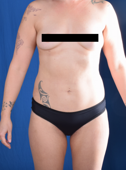 Torso Liposuction Before & After Patient #1420