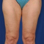 Legs Liposuction Before & After Patient #1487