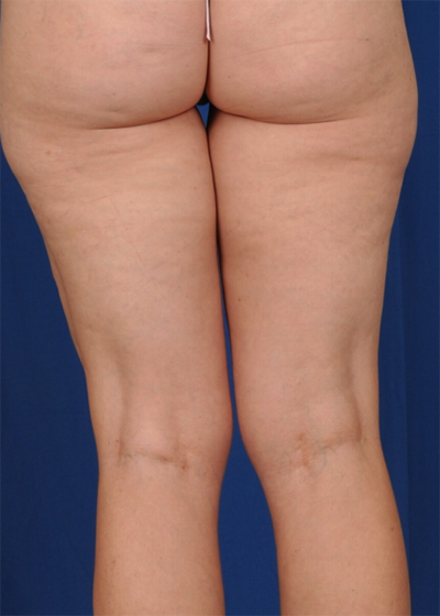 Legs Liposuction Before & After Patient #1487