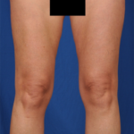 Legs Liposuction Before & After Patient #1496