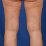 Legs Liposuction Before & After Patient #1496