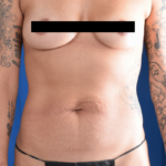 Tummy Tuck Before & After Patient #1508