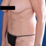 Tummy Tuck Before & After Patient #1513