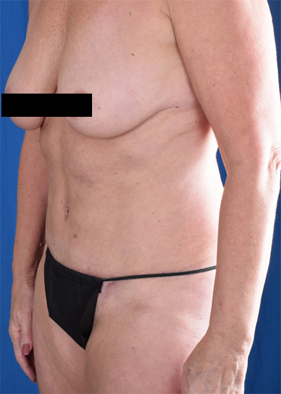 Tummy Tuck Before & After Patient #1513