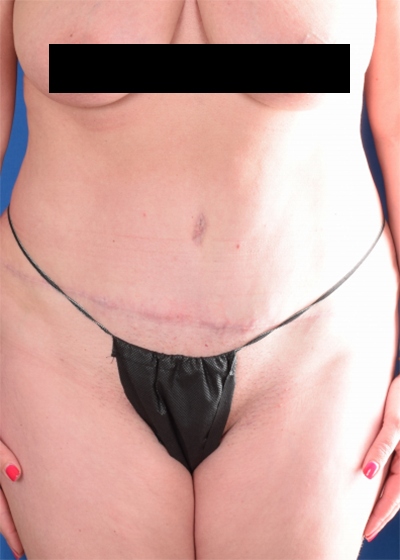 Tummy Tuck Before & After Patient #1525