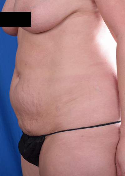 Tummy Tuck Before & After Patient #1525
