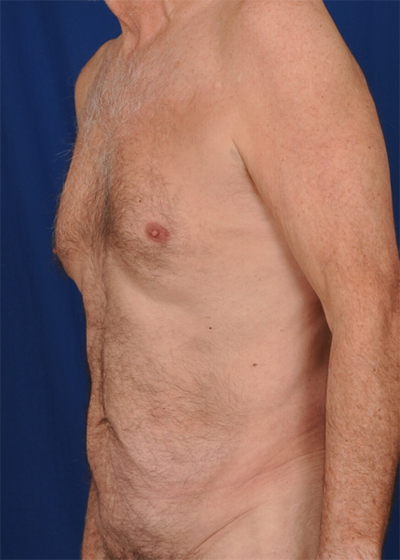 Tummy Tuck Before & After Patient #1532