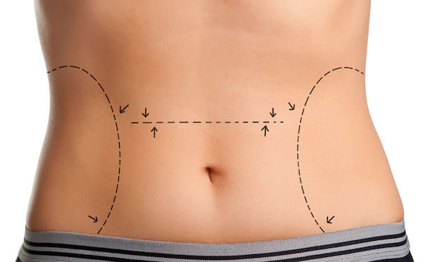 Tummy Tuck Recovery 