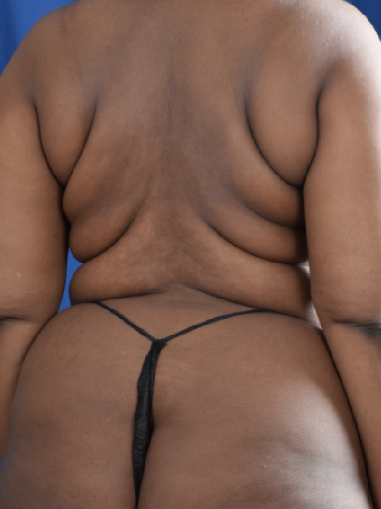 Torso Liposuction Before & After Patient #1555