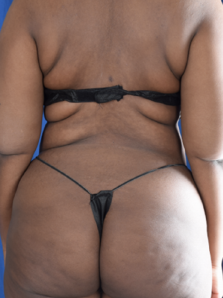 Torso Liposuction Before & After Patient #1555