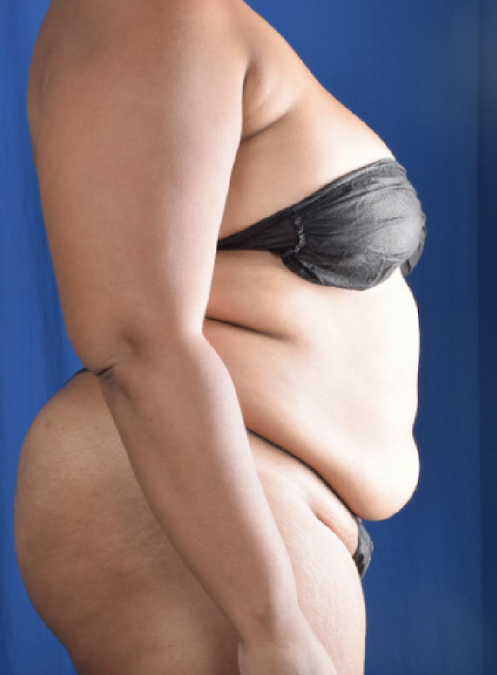 Torso Liposuction Before & After Patient #1558