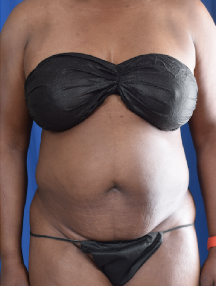 Tummy Tuck Before & After Patient #1563