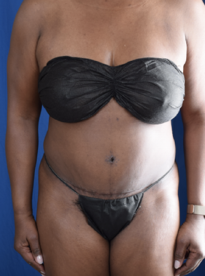 Tummy Tuck Before & After Patient #1563