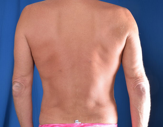 Torso Liposuction Before & After Patient #1709