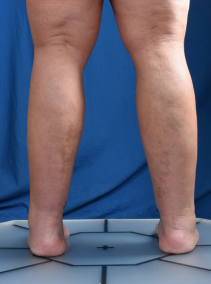 Legs Liposuction Before & After Patient #1704
