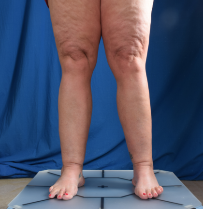 Legs Liposuction Before & After Patient #1704