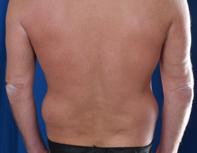 Torso Liposuction Before & After Patient #1709