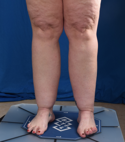 Legs Liposuction Before & After Patient #1704