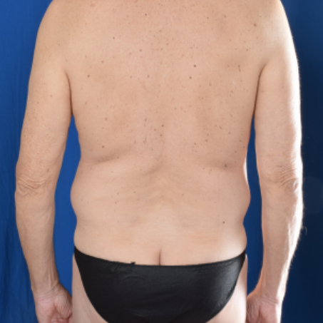 Torso Liposuction Before & After Patient #1665