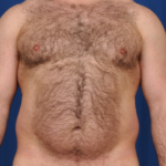Torso Liposuction Before & After Patient #2027