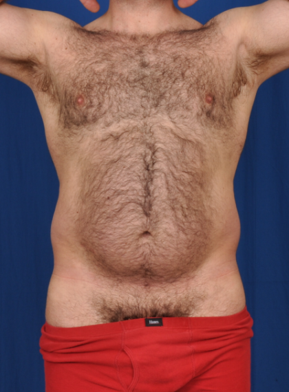 Torso Liposuction Before & After Patient #2027