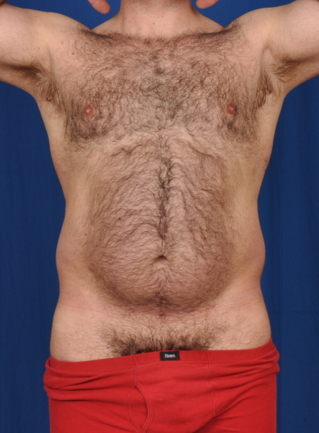 Torso Liposuction Before & After Patient #2027