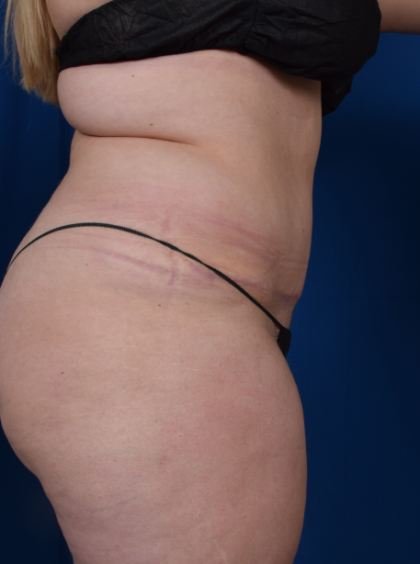 Tummy Tuck Before & After Patient #2041