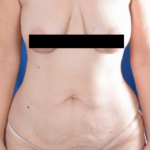 Tummy Tuck Before & After Patient #2048