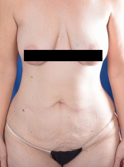 Tummy Tuck Before & After Patient #2048