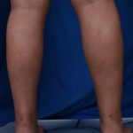 Legs Liposuction Before & After Patient #2009