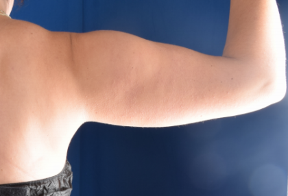 Arms Liposuction Before & After Patient #1969