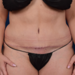Tummy Tuck Before & After Patient #2041