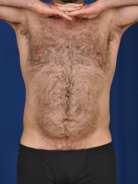 Torso Liposuction Before & After Patient #2027