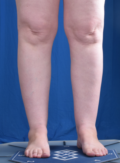 Legs Liposuction Before & After Patient #2000