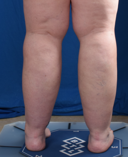 Legs Liposuction Before & After Patient #1992
