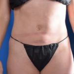 Torso Liposuction Before & After Patient #2016