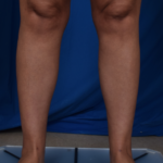 Legs Liposuction Before & After Patient #2009