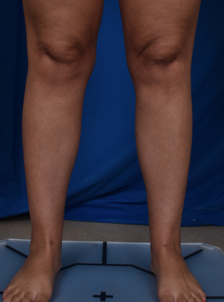 Legs Liposuction Before & After Patient #2009